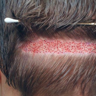 Hybrid Hair  Transplant